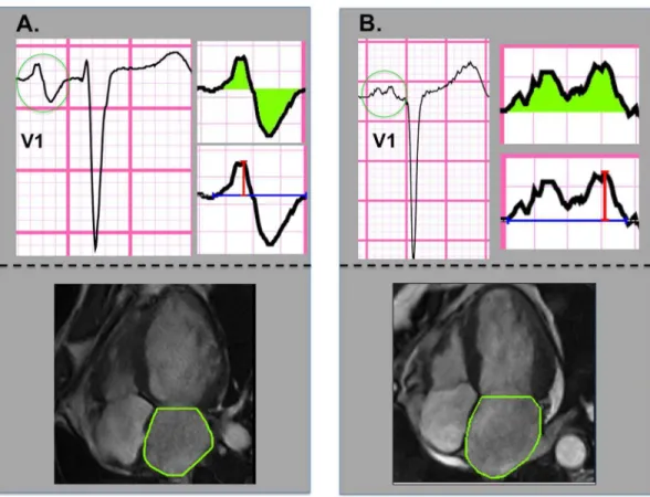 Table 1 details clinical and imaging characteristics of the population, stratified in relation to presence or absence of  CMR-evidenced LA dilation (categorized based on an established CMR cutoff [15 cm 2 /m 2 ]