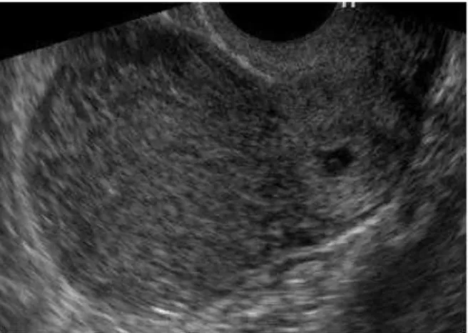 Figure  1:    Transvaginal  ultrasonography  showing gestational sac with foetal echoes suggestive of cervical pregnancy