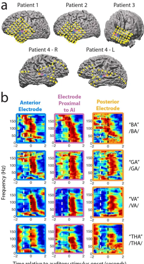 Figure 2. Electrode locations and responses to auditory stimuli on STG electrodes. a, Electrode locations for five hemispheres in four patients