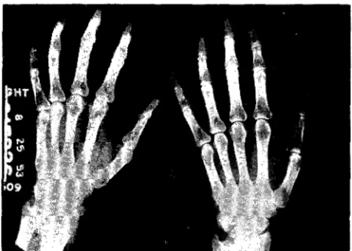 FIG. 4 — Radiografias de las  manos de un paciente  con evidencias de  estrechamiento de las  articulaciones  interfa-lângicas proximales