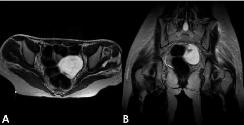 Fig. 2. Axial T1 weighted MRI (A) and coronal T2-weighted MRI (B): a multilocular mass is present superior to the uterus, inseparable from the left ovary.
