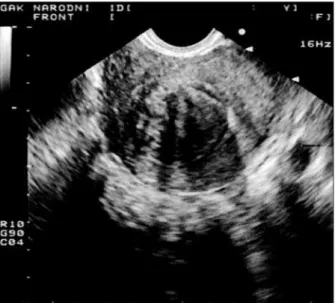 FIGURE  2a.   Suspected  submucous  myoma  (transvaginal  ultrasono- ultrasono-gram).