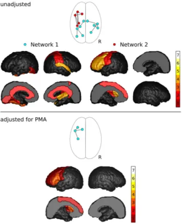 Figure 2. Results of the NBS analysis of FA. Shown are the network components with significantly decreased FA in preterm infants, and frequency with which cortical regions were associated with changes in FA of their connections.