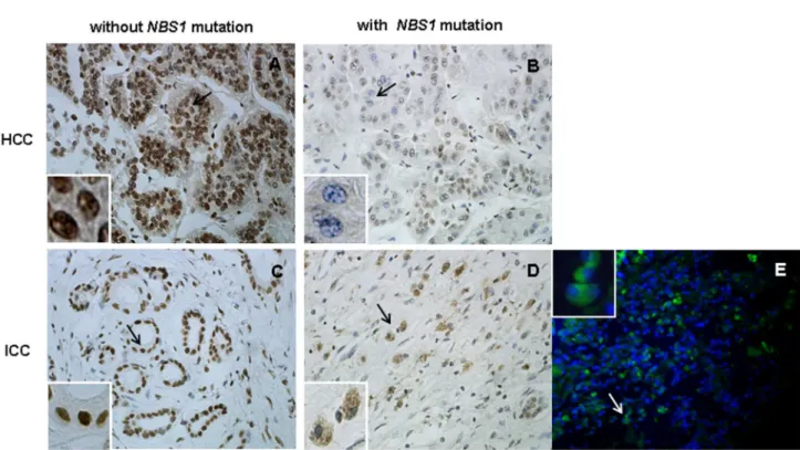 Figure 3.  Mre11 nuclear staining in tumor cells with or without NBS1 mutations.  Upper panel: IHC of a pair of HCC cases, (A) without NBS1 mutation (case γ74) and (B) with NBS1 mutation S6γγT (case γ75)