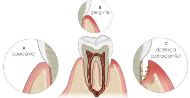 Figura 1. Progressão da doença periodontal do estado de saúde à inflamação severa e perda óssea  (25)