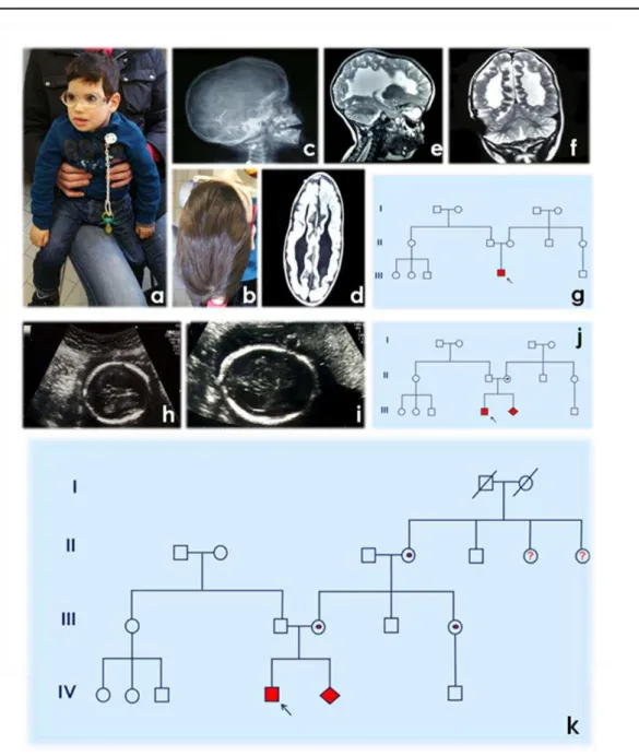 Figure 1. a,b. Proband/patient phenotype; c. RTG  – laterolateral radiography; d. MR - horizontal section;   e