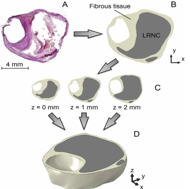 Fig 1. The reconstruction procedure of a 2-mm thick 3D ground truth carotid plaque model illustrated using an example