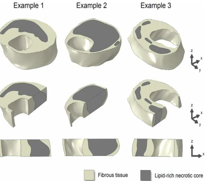 Fig 2. Three examples of the 3D ground truth plaque models (top row). Longitudinal cross-sectional views (middle and bottom rows) illustrate axial morphological variations.
