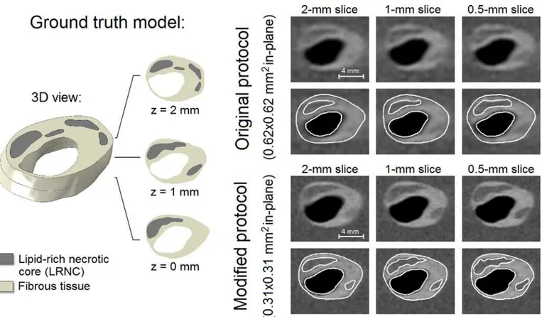 Fig 4. An example of a 3D ground truth input model (left) with its 6 simulated in vivo carotid MR images with different voxel dimensions and segmentation (right)