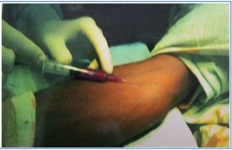 Fig. 1: METHOD TO DRAW AUTOLOGUS BLOOD 