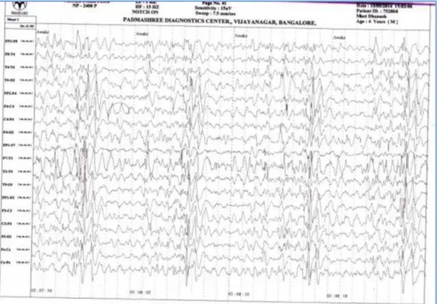 Figure  1:  Electroencephalogram  (EEG)  at  the  time  of  presentation.  EEG  reveals  periodic  bursts  of  high-amplitude,  slow-wave  complexes