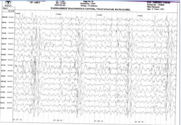 Figure  1:  Electroencephalogram  (EEG)  at  the  time  of  presentation.  EEG  reveals  periodic  bursts  of  high-amplitude,  slow-wave  complexes