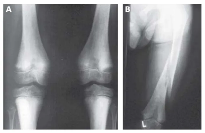 Abbildung 2 : Konventionell radiologische Diagnostik.  Röntgenbild A  zeigte ein a. p.- p.-Röntgenbild beider Kniegelenke