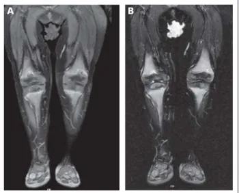 Abbildung 3:  Magnetresonanztomographie.  Bild A:  MRT (T1w, fettsupprimiert, post KM i.v.) coronar: deutliche Irregularität der metaphysären Endabschnitte