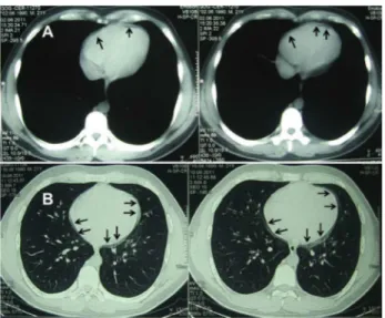 Figure  2.  Computed  tomography  scan  of  the  chest  reveals  pericardial  thickening  with  minimal  radiolucency  mimicking  pneumopericardium  (A),  (arrows)