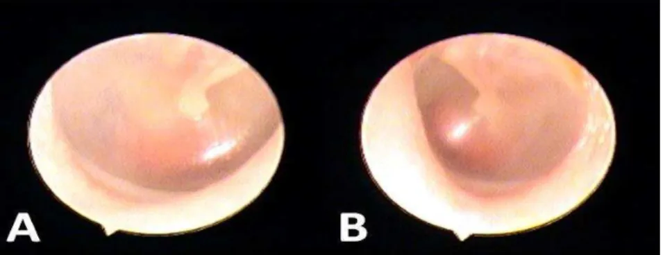 Fig 1: O otoscopic View