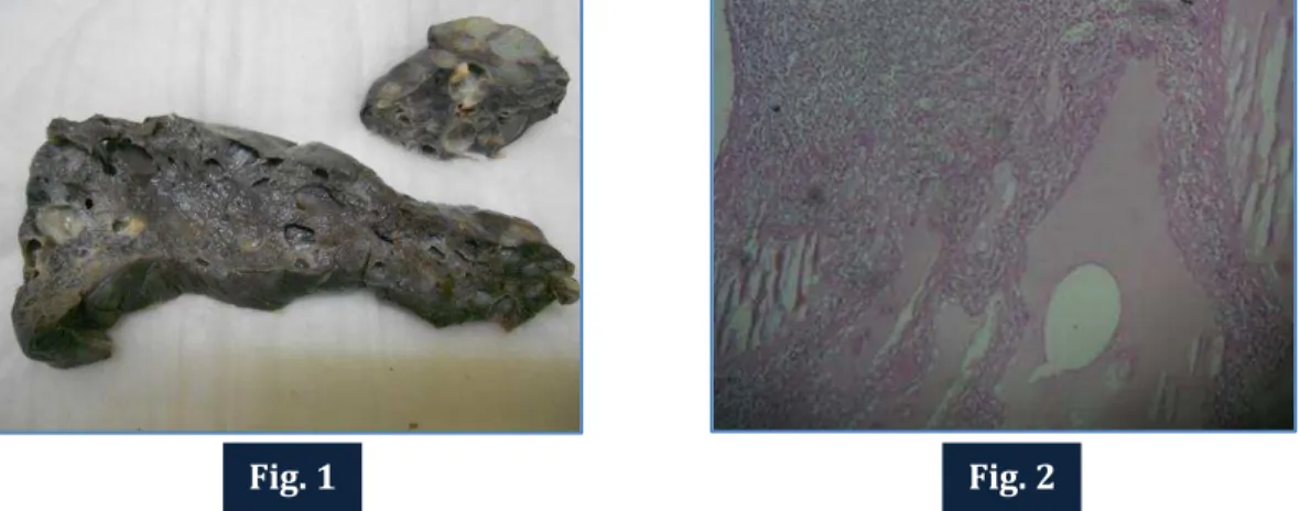 Fig. 1: Cut section of spleen showing cysts of varying sizes ranging from 0.1cm to 2.5cms in diameter  filled with gelatinous material