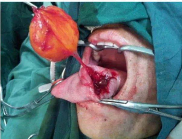 Fig  3:  The  tumor,  which  was  yellowish  in  color,  8  cm  in  diameter,  and  well-encapsulated,  was  completely removed