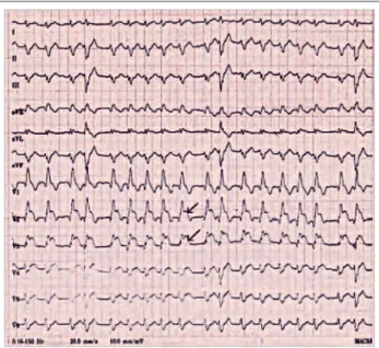 Abbildung 1:  EKG. Markierung bei Ableitung V2–3 mit ST-Hebung.