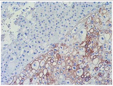 Abbildung 1: Hybrid onkozytär chromophober Tumor: immunhistochemische Färbung mit CK7 (Cytokeratin 7); der  Onkozytomanteil im linken oberen Bereich färbt sich nicht (blau) an, der Anteil des chromophoben Karzinoms im  rechten unteren Bereich färbt sich br