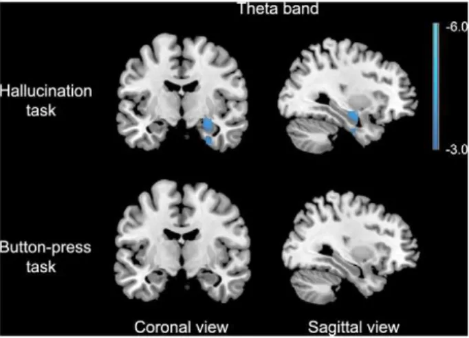 Figure 2. Results for the AVH onset analysis superimposed on a template brain. Data are presented in neurological convention (right is right)