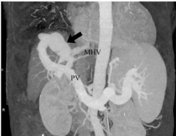 Fig. 1. 3D CT at the portal phase. 3D-CT revealed intrahepatic PSS (arrow) between the portal vein branch (PV) and the middle hepatic vein (MHV).