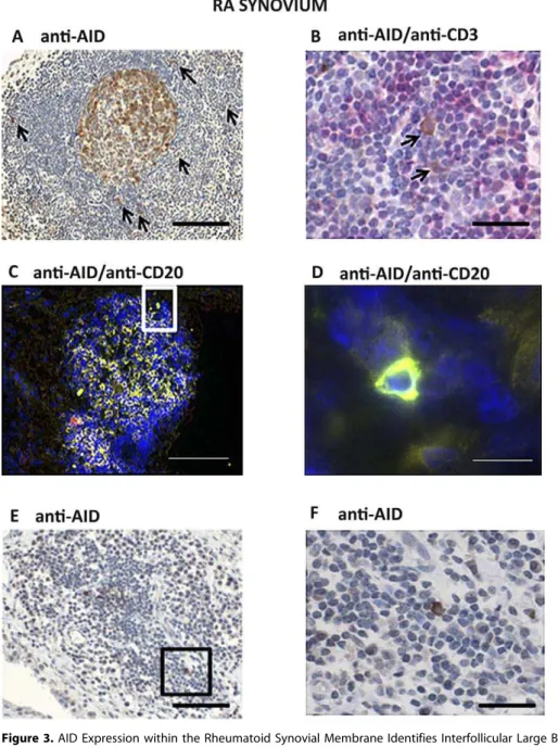 Figure 3. AID Expression within the Rheumatoid Synovial Membrane Identifies Interfollicular Large B Cells