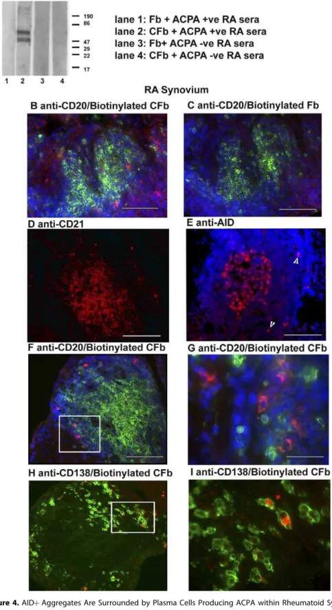 Figure 4. AIDþ Aggregates Are Surrounded by Plasma Cells Producing ACPA within Rheumatoid Synovium