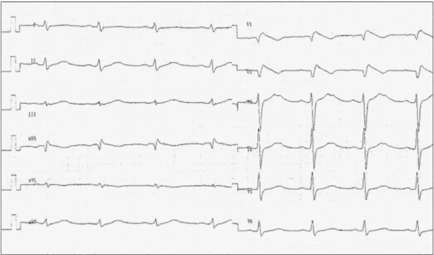 Abbildung 2: Das 12-Kanal-EKG vor der Durchführung des Ajmalin-Tests