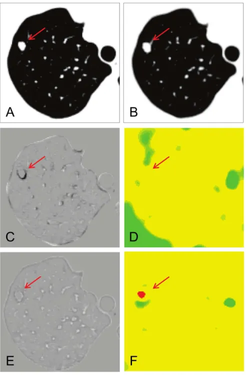 Figure 6. Comparison between cascading a LDDMM and B-spline registration. A metastatic nodule in the right upper lung (red arrow) was growing slightly at clinical follow-up (A: 1st time point, B: 2nd time point)