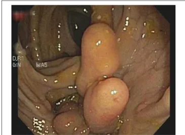 Figure 1.  “Swiss cheese” appearance of the sigmoid colon is  seen here. During the procedure there were similar appearances  in the descending and ascending colon (colonoscopic image).