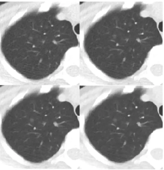 Figure 2. Transverse chest CT images of a patient who had a ground glass opacity nodule in the right upper lobe (arrow)