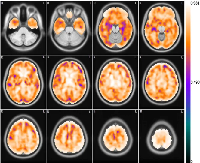 Fig. 4. Mean voxelwise correlation between the set of FDG images and the correspondent set of R 1 (MRTM) images