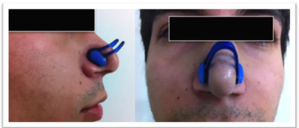 Figura 4 - Obstrução nasal por meio de clip nasal usado para natação. 
