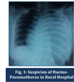 Fig. 1: Suspicion of Haemo- Haemo-Pneumothorax in Rural Hospital 