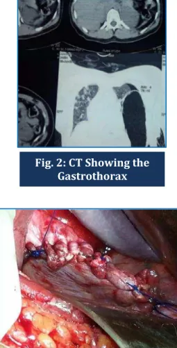 Fig. 3: Open Laparotomy and Closure of Rent Fig. 2: CT Showing the 
