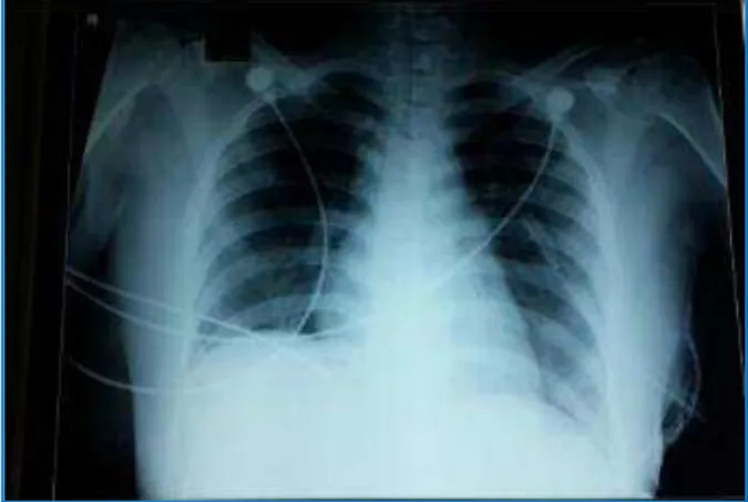 Fig. 5: Portable Chest X-Ray on the 3rd Post-Operative day 