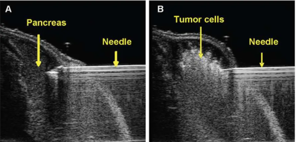 Figure 1. Representative ultrasound images of USGI of tumor cells into the pancreas. A) Shows the 30 gauge needle in mouse pancreas pre-injection