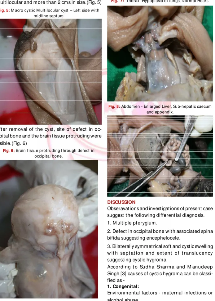 Fig. 5:  M acro cyst ic M ult ilocular  cyst  – Left  side w it h m id line sept um