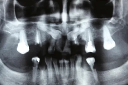 Fig 1- Ortopantomografia apresentando os dois caninos superiores inclusos 