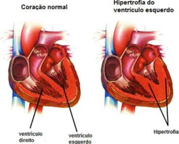 Figura 3 - Esquema representativo da hipertrofia do ventrículo esquerdo