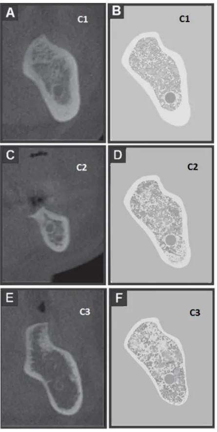 Figura  3 – Avaliação qualitativa da qualidade  da cortical inferior  da mandíbula (índice  IMCT)  em cortes transversais de exames de TCFC, As imagens A, C e E representam  os  cortes  transversais  e  as  imagens  B,  D  e  F  são  desenhos  esquemáticos