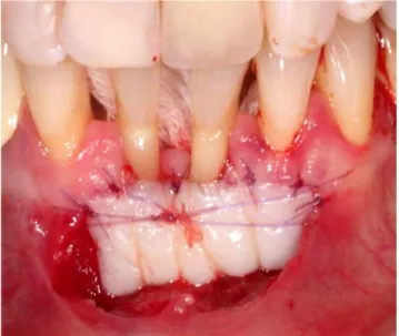 Fig. 3. Split thickness preparation of the recipient area. /Preparation of the recepient area/