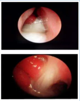 Fig. 3: Showing Significant Radiological Improvement  after Treatment with Hypertonic saline (3%) Nasal Drops 