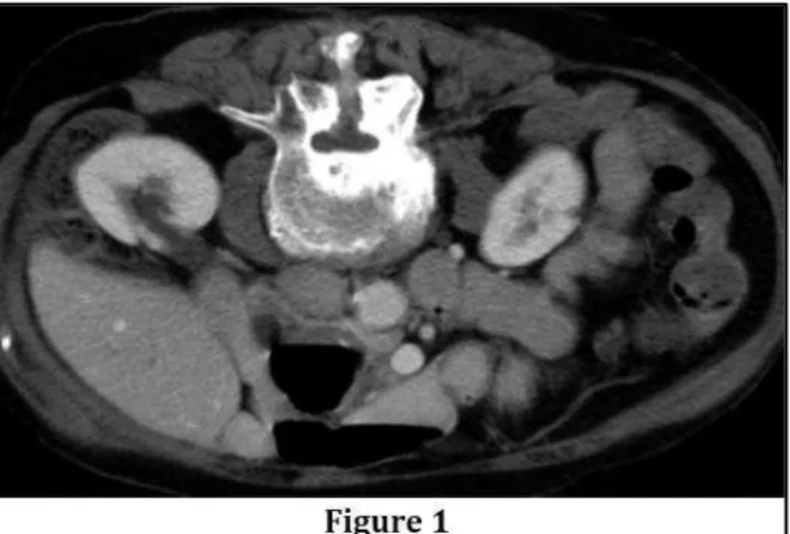 Figure  1: 64-year-old  male  with  retrorenal  colon.  Axial  enhanced  CT  images  show  colon  wrapping  around lower pole of kidneys and extending posteromedially to psoas muscles