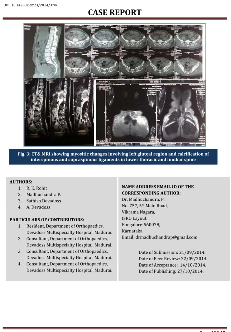 Fig. 3: CT&amp; MRI showing myositic changes involving left gluteal region and calcification of  interspinous and supraspinous ligaments in lower thoracic and lumbar spine