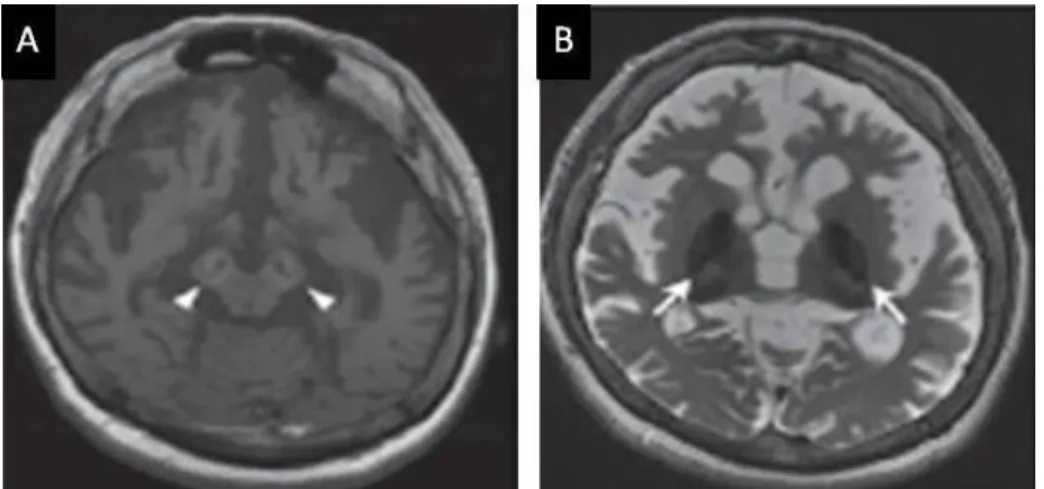Figure 1.4 – Example of a brain MRI with WDR45 mutation. 