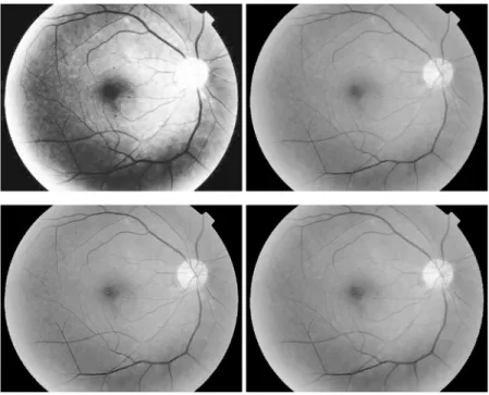 Fig 4. Retinal image enhancement for detection of microaneurysms in diabetic retinopathy (from top- top-left to bottom-right): results by histogram equalization, ADSF filtering after Gamma manipulation, Laplace operation after Gamma manipulation and self-s