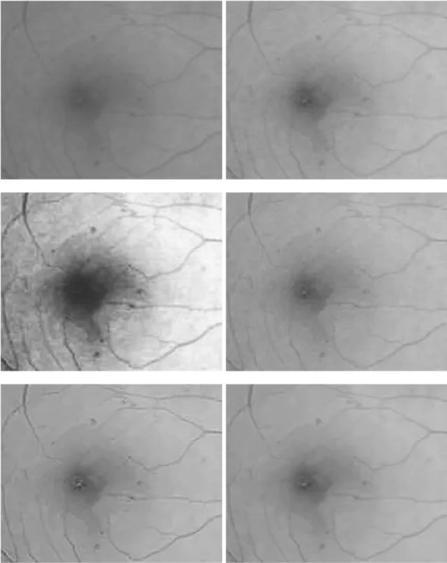 Fig 5. Zoomed parts of enhanced retinal images for microaneurysm detection (from top-left to bottom-right): original image, results by Gamma manipulation, histogram equalization, ADSF filtering after Gamma manipulation, Laplace operation after Gamma manipu
