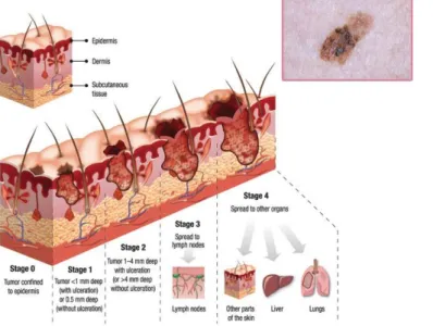 Figure  1.2.1  –  Progression  of  skin  cancer.  Squematic  of  histologic progress of melanoma throughout its many stages 